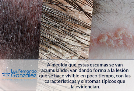 La Dermatitis Seborreica Produce Alopecia? Te Contamos Todo